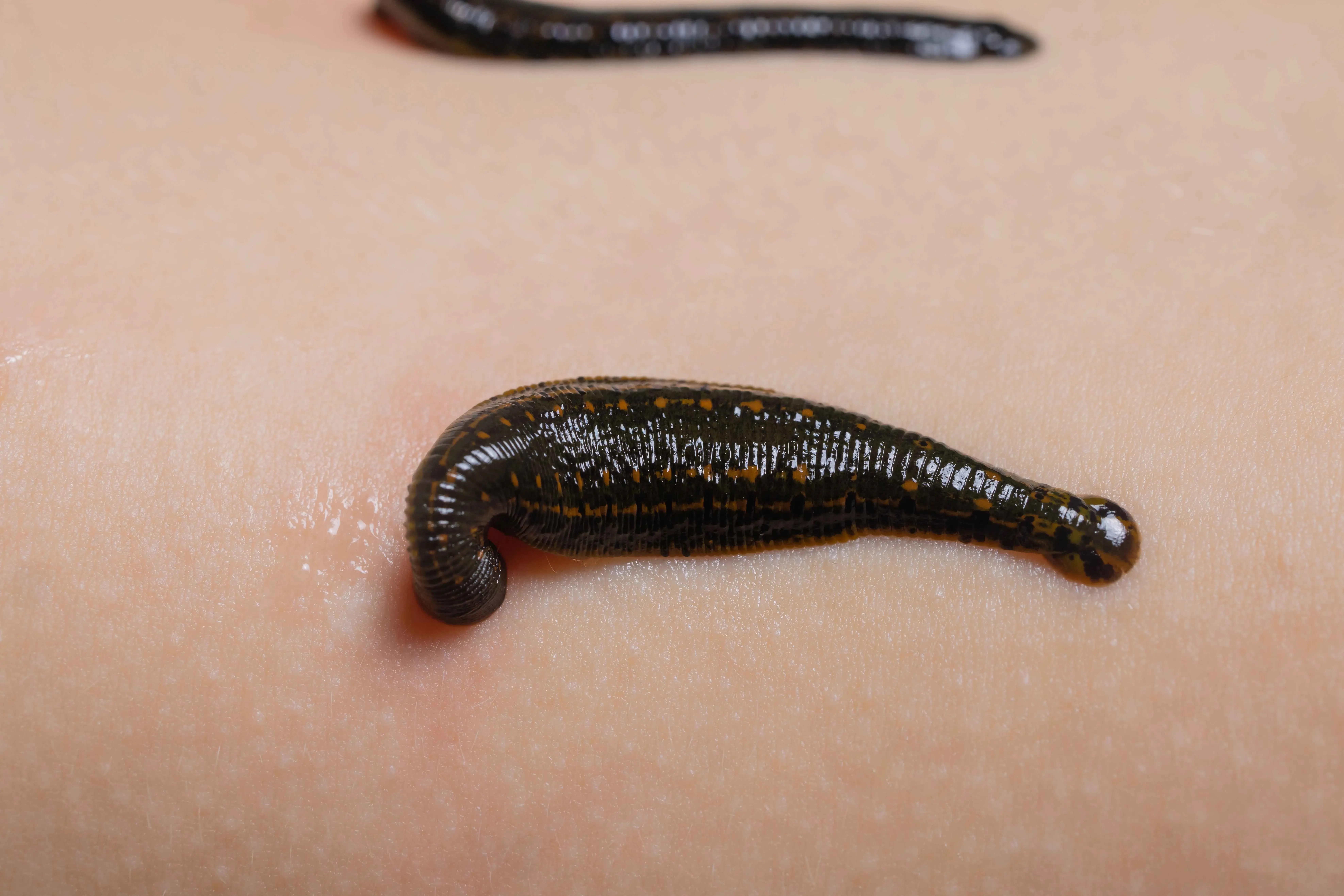 An Ayurvedic bloodletting detox therapy that expels vitiated blood, supports healing of skin disorders, reduces Pitta aggravation, improves circulation, and helps conditions like eczema, acne, varicose veins, and inflammatory issues.